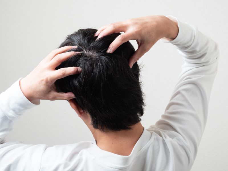 【毛髪診断士監修】フケの原因は？効果的な対策方法やフケをともなう病気も解説