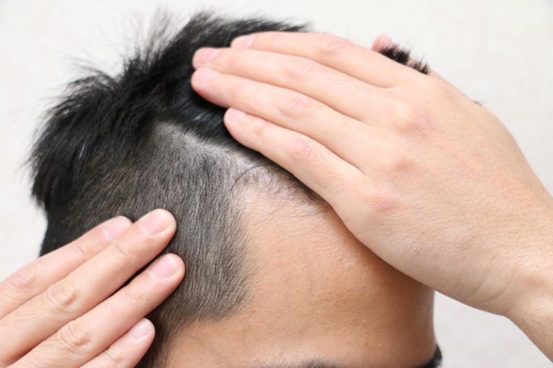 【毛髪診断士監修】富士額とＭ字型の薄毛（ハゲ）には【違い】がある2つの見分け方とは